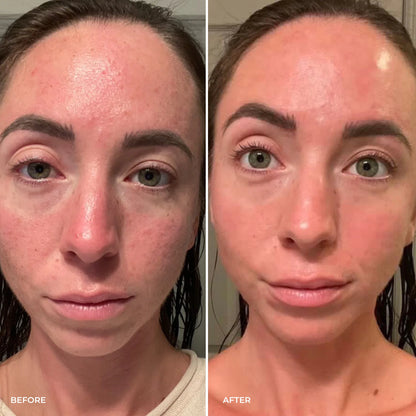 Parches PuraDerma™  - Reduce las ojeras