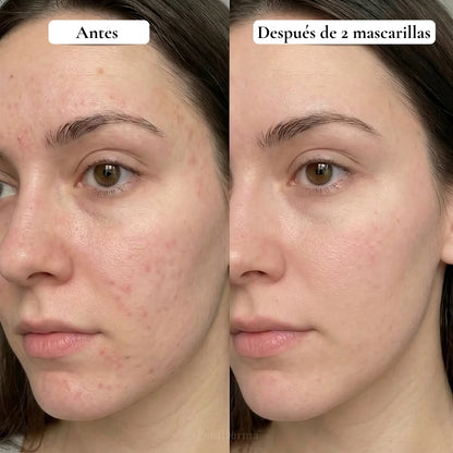 PuraDerma™ Mascarilla Hidrocoloide Anti-Imperfecciones Cobertura Total
