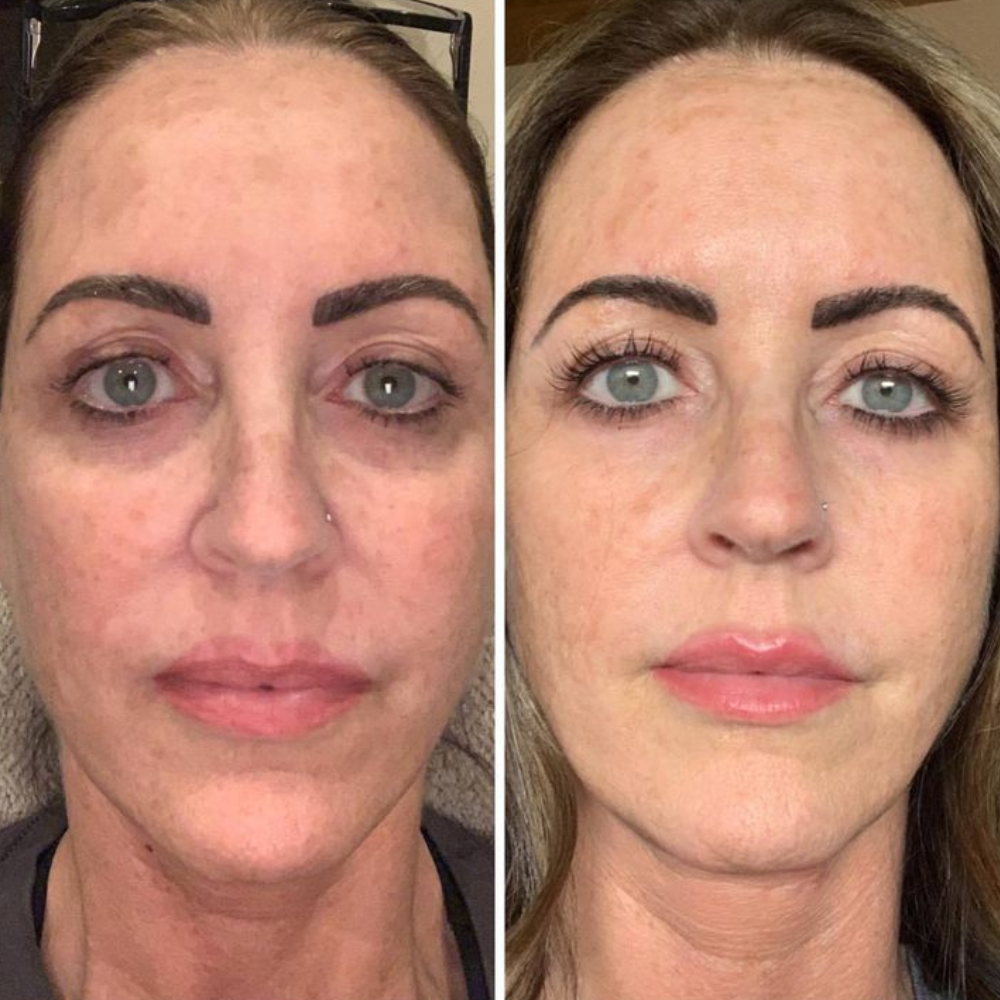 PuraDerma™ Cuidado de Ojos Pro
